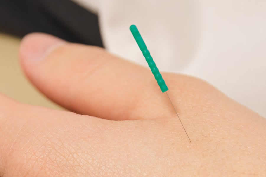 What does an Acupuncturist do What does an Acupuncturist do